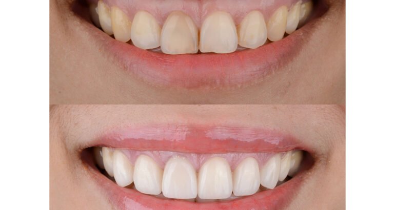 Gummy Smile